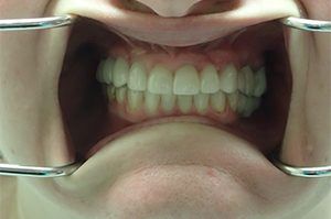 A close up of a person 's mouth with braces on their teeth.