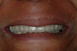 A close up of a man 's mouth with white teeth.