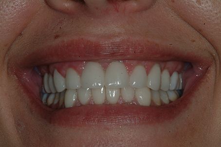 A close up of a woman 's smile with white teeth.