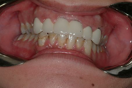 A close up of a person 's mouth with a dental mirror.