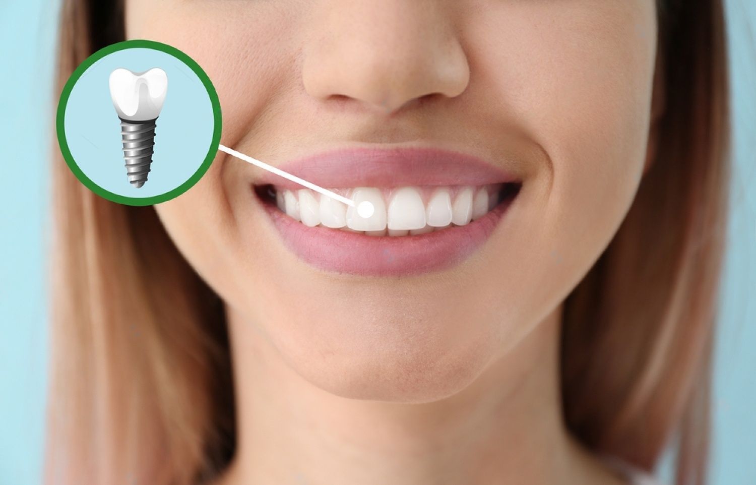 Dental Implants