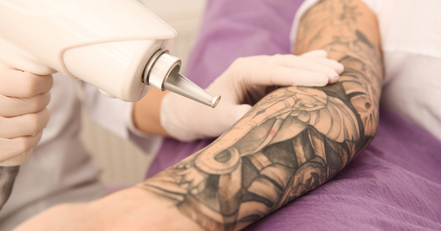 Transform Your Ink Regrets | Tattoo Removal in Lafayette | youbaby