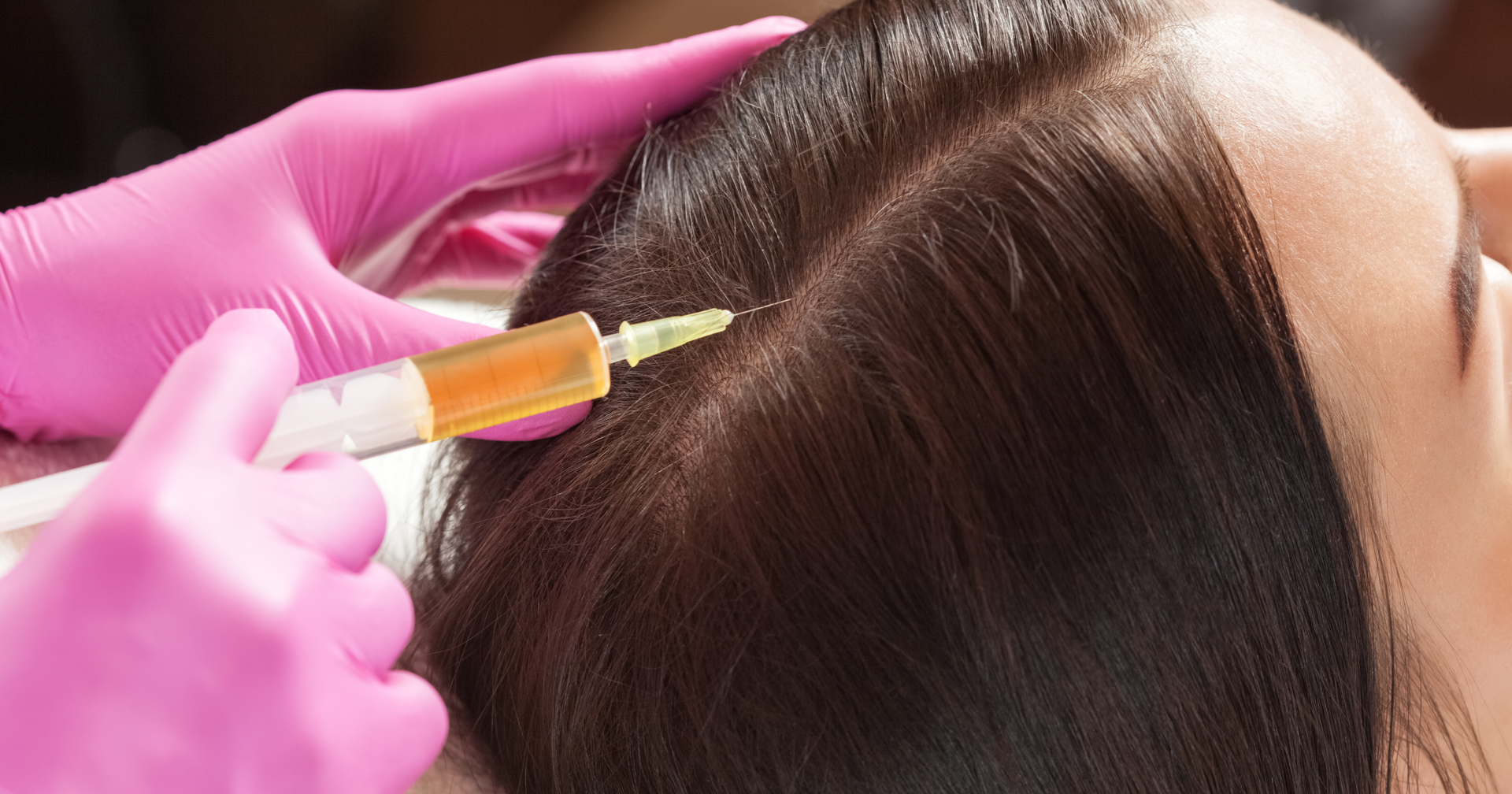 Restore Your Hair, Reclaim Your Confidence: PRP Injections at Kellogg Clinic