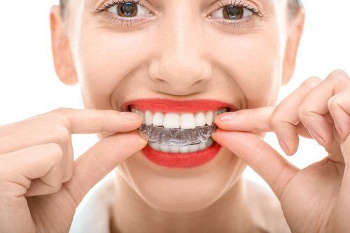 apparecchio Invisalign