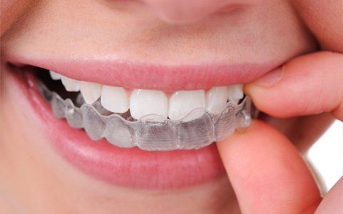 Invisalign® First For Children - Aran Orthodontics