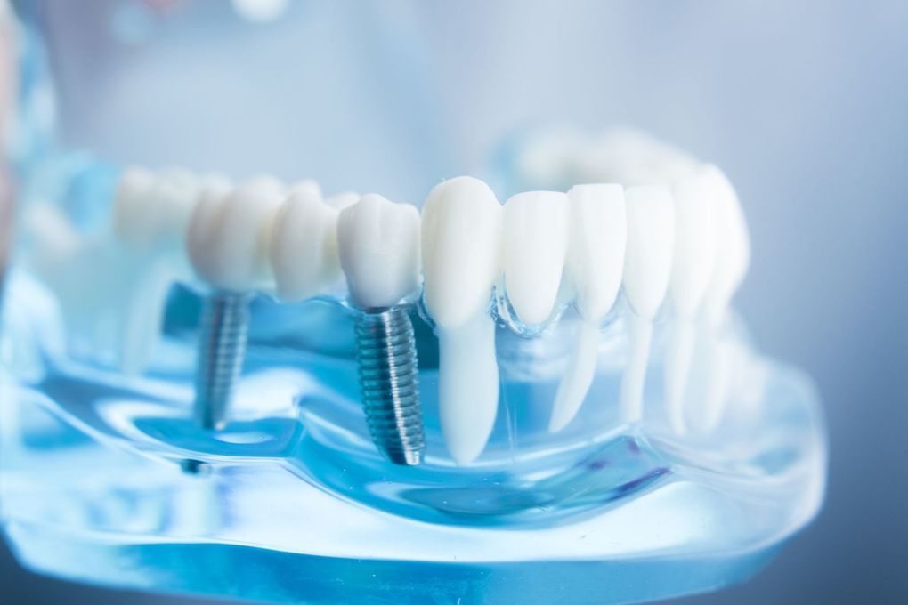 impianto dentale