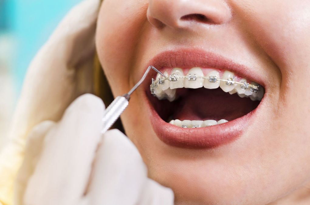 Una donna con l'apparecchio ortodontico si sta facendo visitare i denti dal dentista.