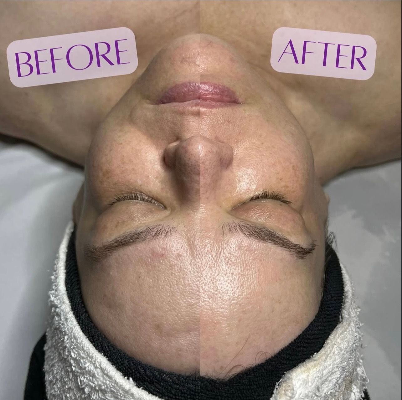 A woman 's face is shown before and after a facial treatment.