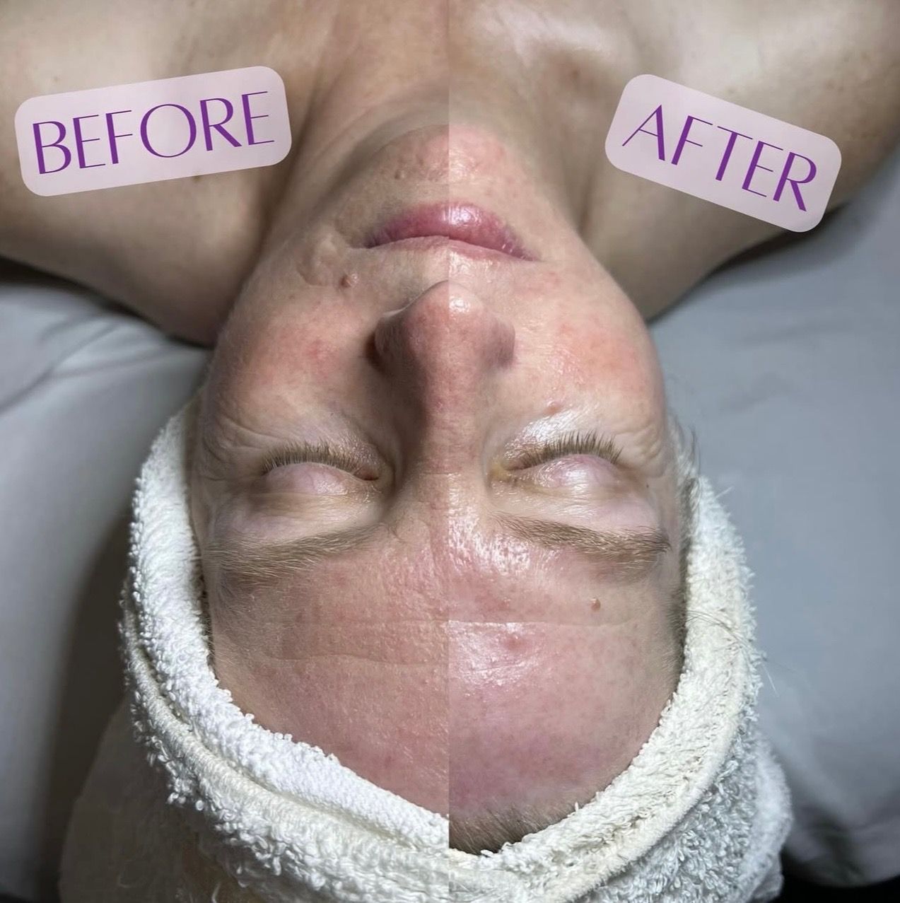 A before and after picture of a woman 's face with a towel around her head.