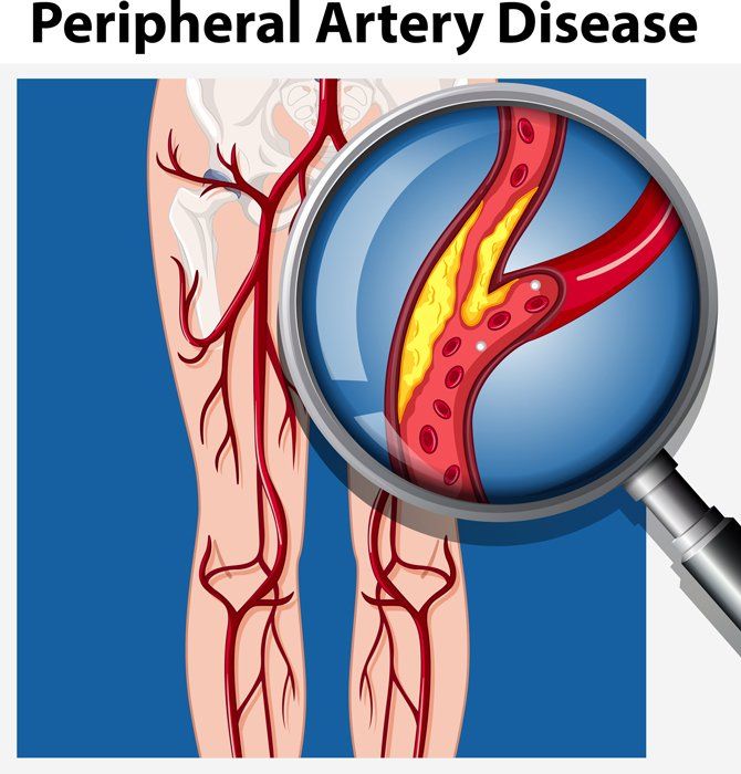 Peripheral Artery Disease — St. Clair Shores, MI — Eastlake Cardiovascular, P.C.