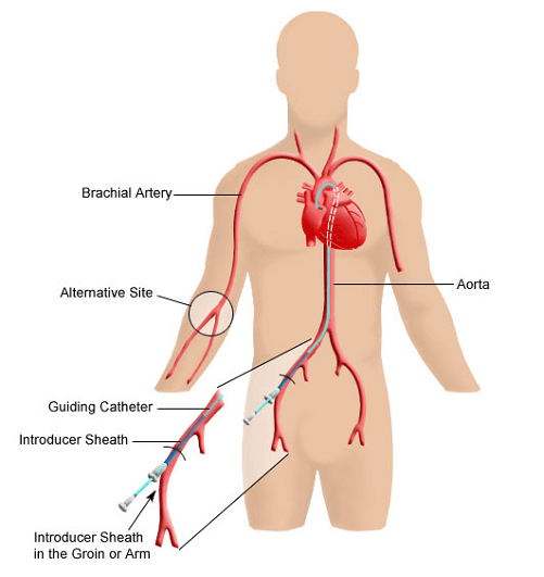 Cardiac Catheterization — St. Clair Shores, MI — Eastlake Cardiovascular, P.C.