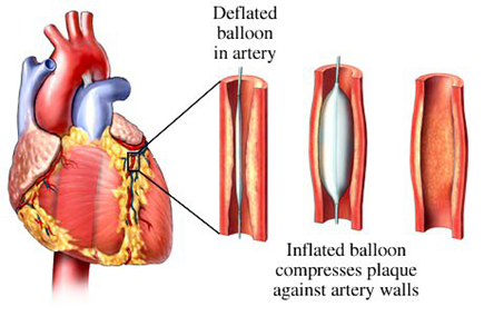 Coronary Angioplasty — St. Clair Shores, MI — Eastlake Cardiovascular, P.C.