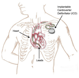 Cardioverter Defibrillator — St. Clair Shores, MI — Eastlake Cardiovascular, P.C.