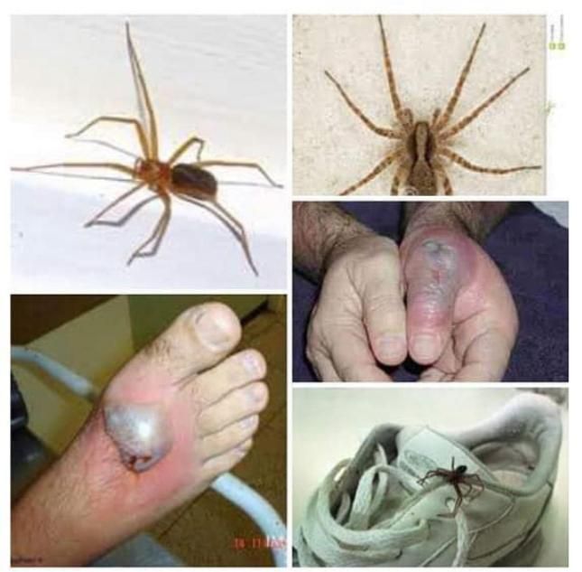 Víctimas de arañas y picaduras: araña en el zapato, araña agrandada, lesiones en manos y pies.