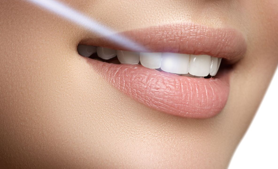 trattamenti laser per sbiancamento denti