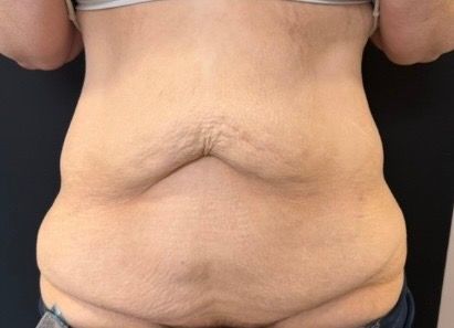 Close-up of a torso with a prominent abdominal fold, wearing a gray top and dark waistband.