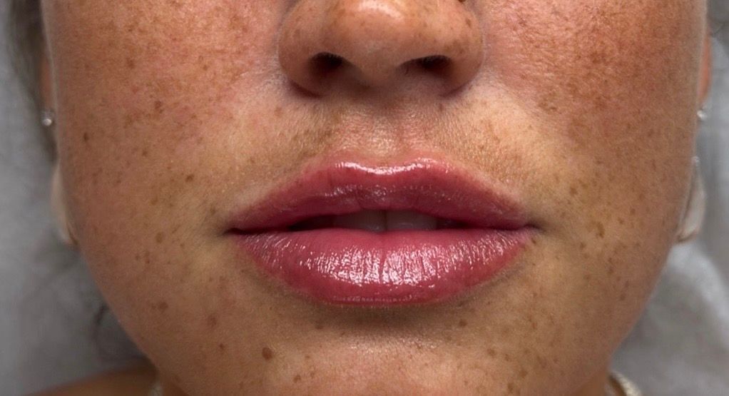 Close-up of lower face with glossy pink lips and a light dusting of freckles