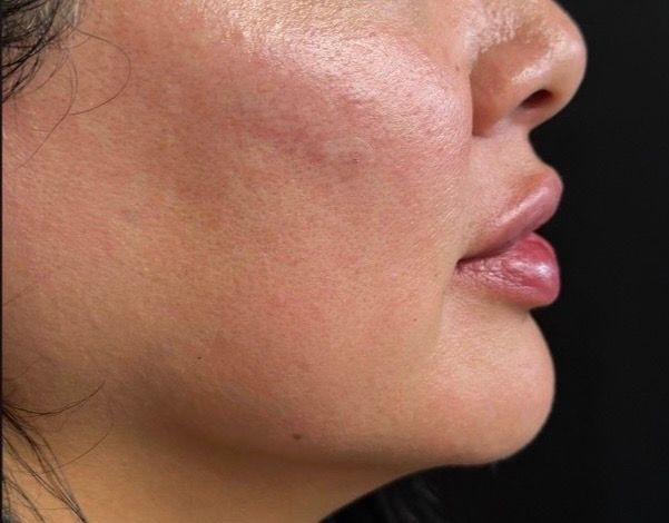 Side profile of a person’s face with visible cheek acne and glossy pink lips