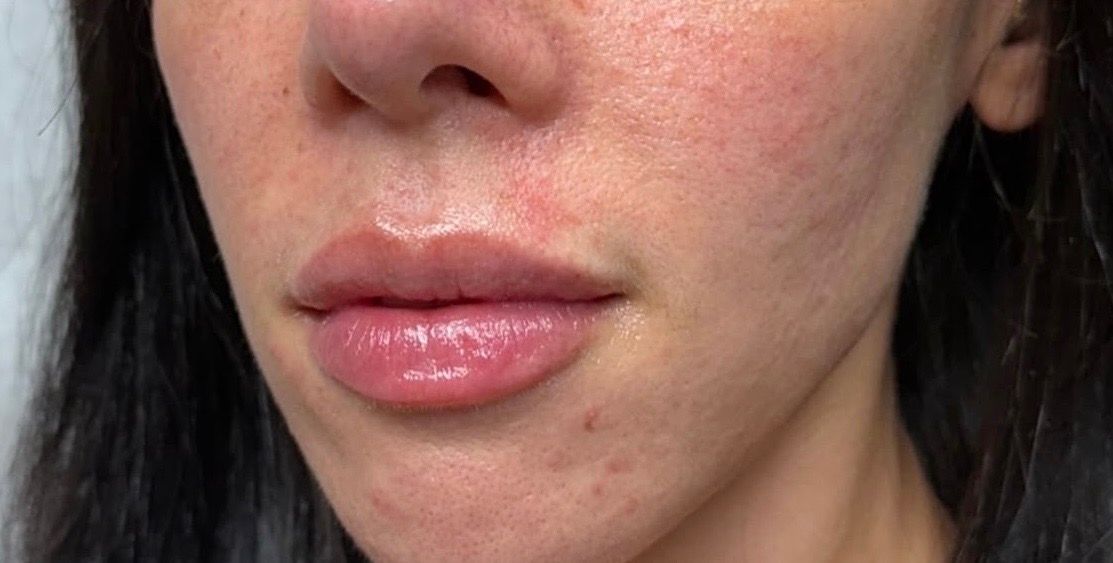 Close-up of a person’s lower face with glossy lips and a small dark mark on the chin.