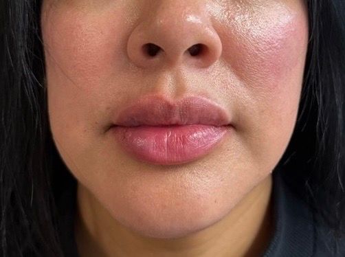 Close-up of lips and lower face with visible cheek redness and natural makeup