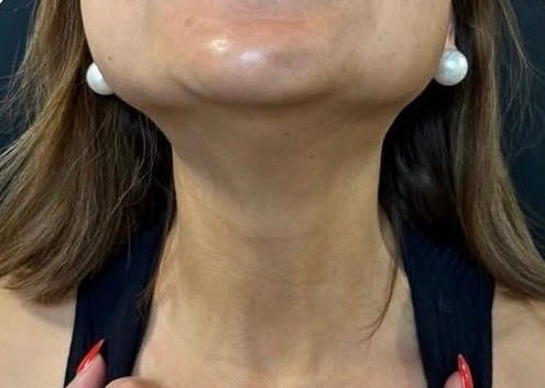 Close-up of a woman’s neck and chin with a visible neck contour and white stud earrings