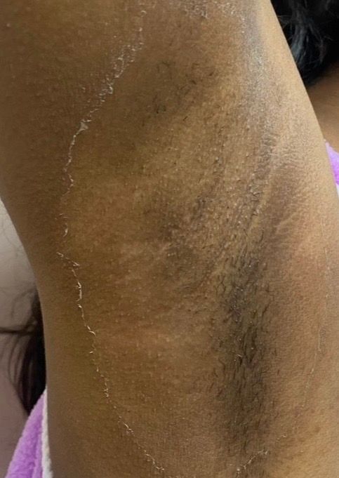 Close-up of a person’s upper arm with dry, flaky skin and a visible scratch mark