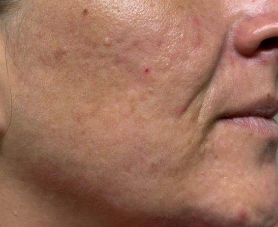 Close-up of a cheek and jawline with visible acne scars and redness