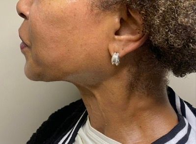 Side profile of a person’s neck with a raised, swollen area under the jaw and a small hoop earring.