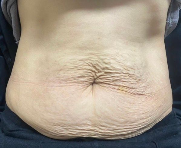 Close-up of a bare abdomen with a prominent navel and visible abdominal folds