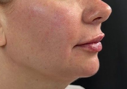 Side profile of a person’s face with visible cheek redness against a dark background
