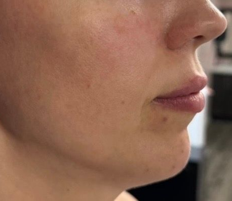 Side profile of a person’s face showing a small red blemish on the cheek and chin, wearing a stud earring.