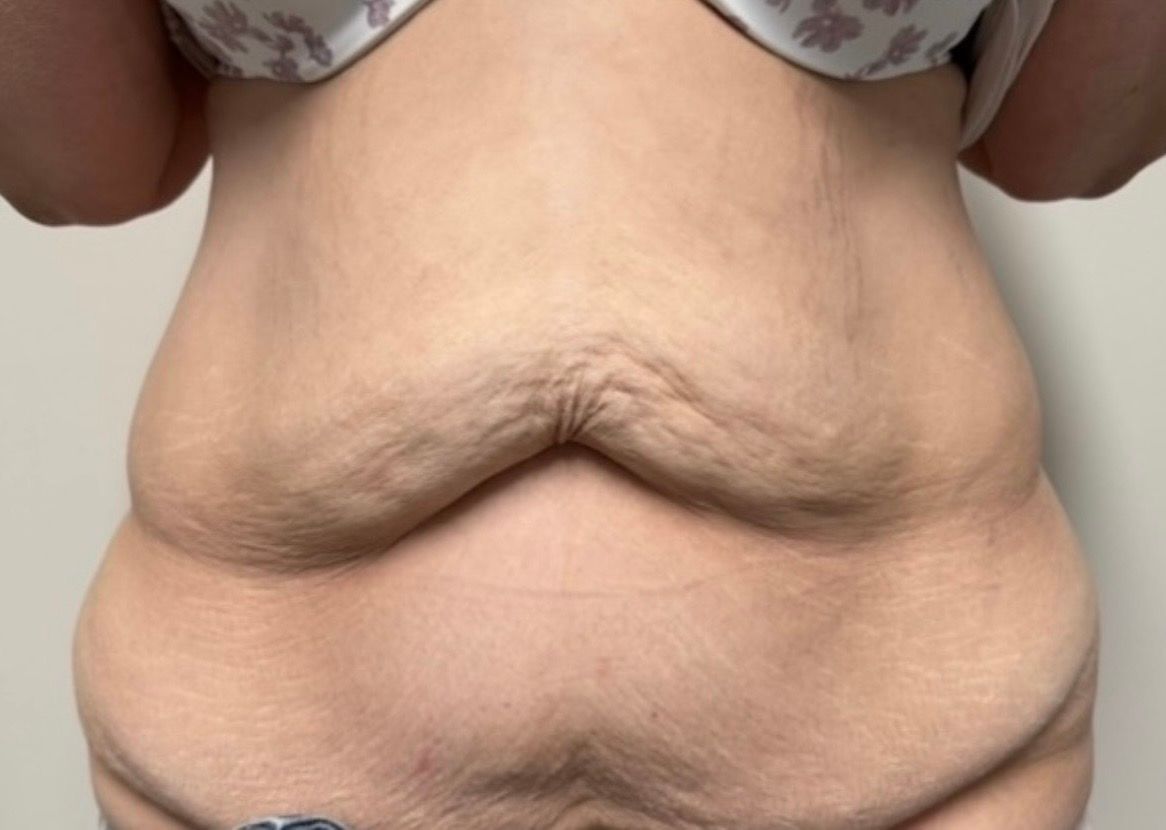 Close-up of a bare midsection with a folded abdominal roll under a patterned bra top.