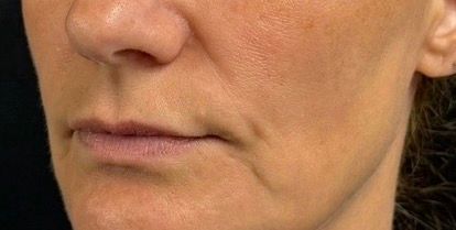 Close-up of a person's lower face and mouth with neutral expression