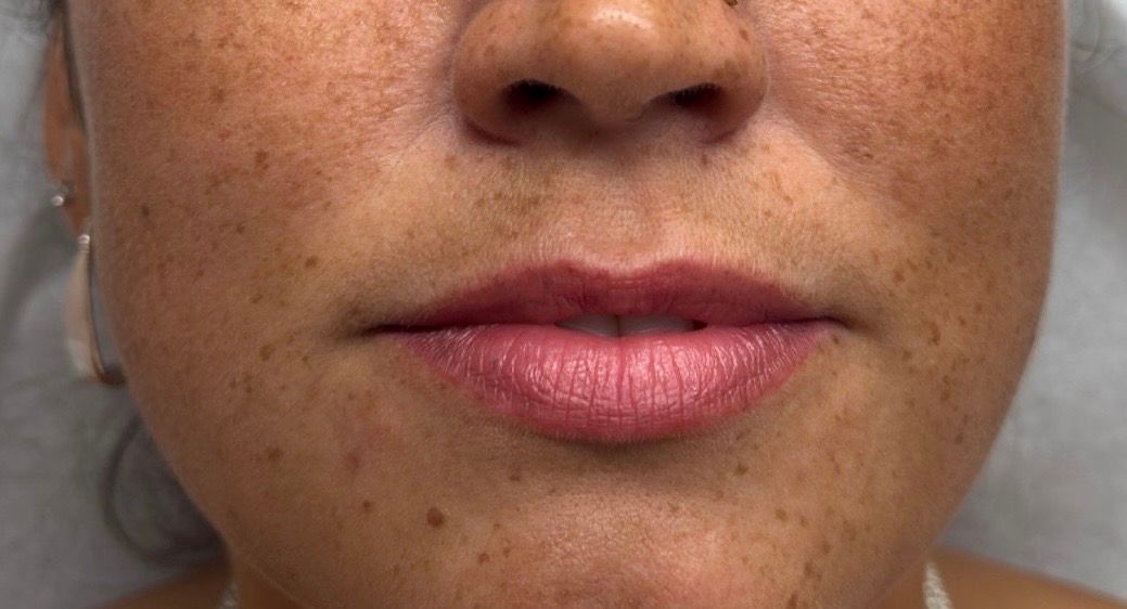 Close-up of a person's lower face with pink lips and visible freckles on the cheeks