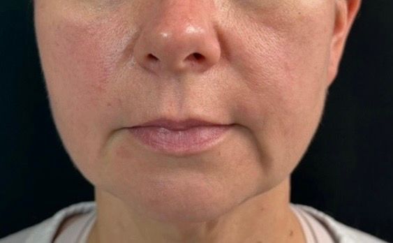 Close-up of a person's lower face with red, patchy skin and mild facial swelling.