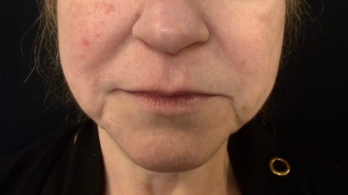 Close-up of a person's lower face and neck, with a neutral expression and a black background.