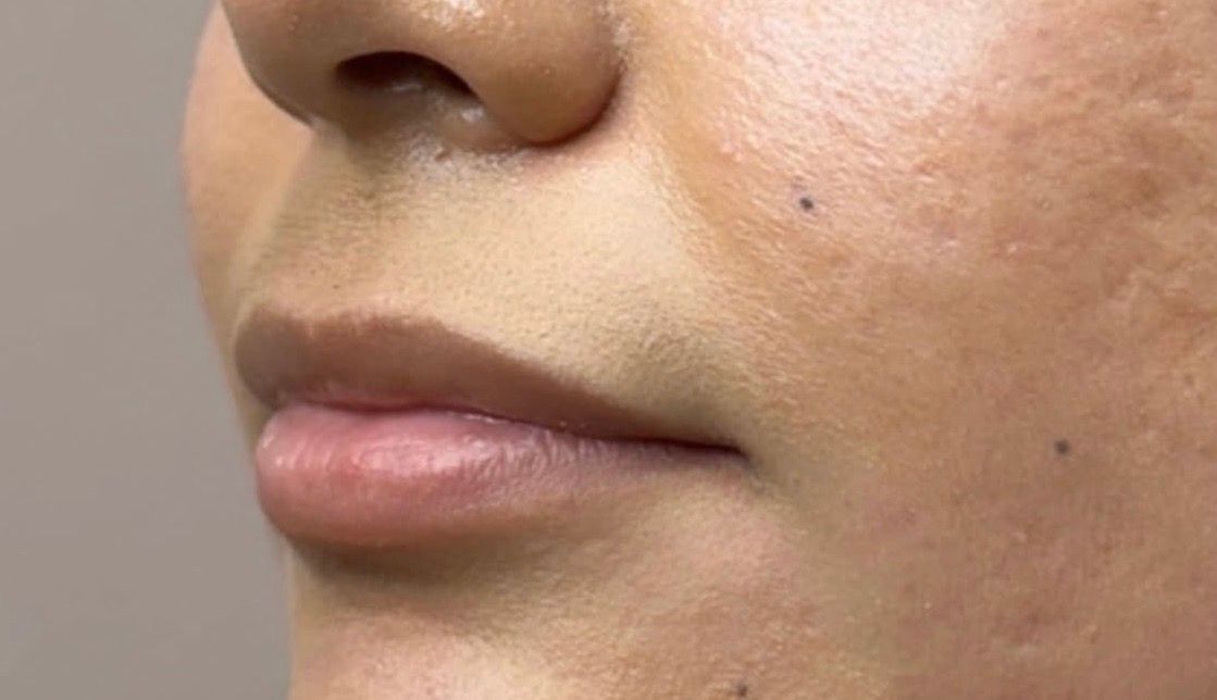 Close-up of a person’s lower face with a small mole on the cheek and neutral expression