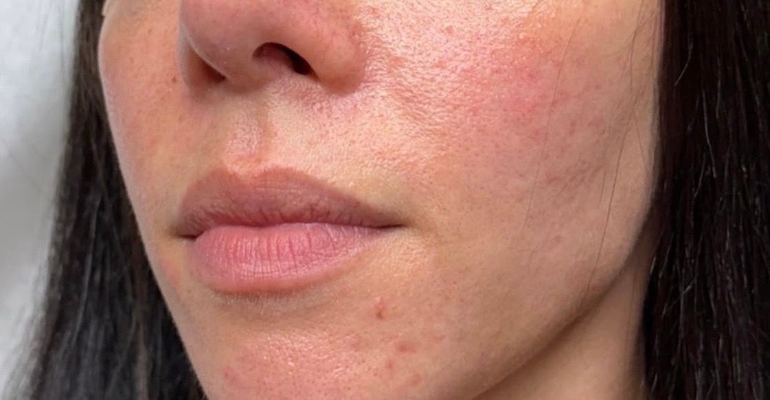 Close-up of a person’s lower face with mild cheek redness and natural lips