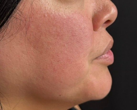 Side-profile close-up of a woman’s cheek and jaw with reddish skin and slight facial hair.