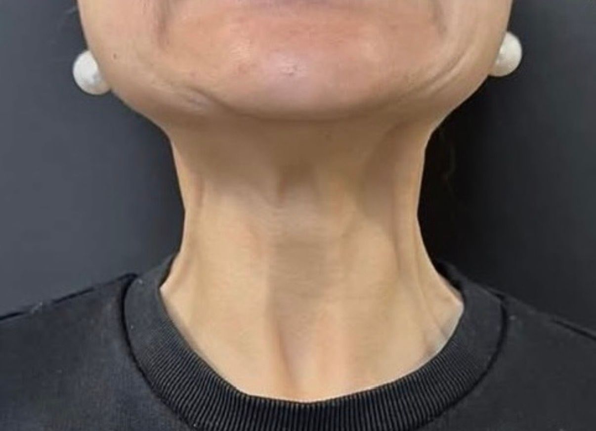 Close-up of a person’s neck and lower face against a dark background, wearing a black top.
