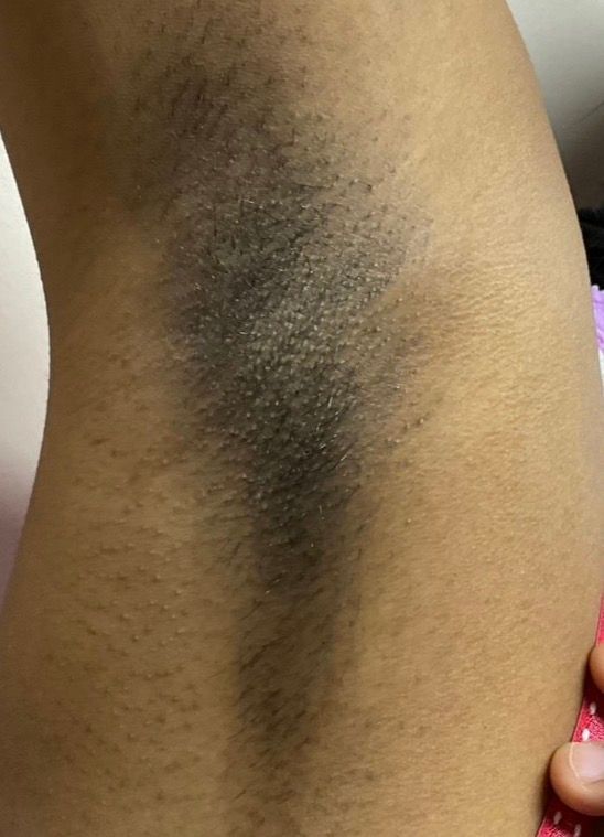 Close-up of a dark underarm with visible textured skin and sparse hair.