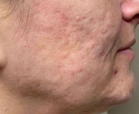 Close-up profile of a person's cheek and jaw with visible acne scars and skin texture