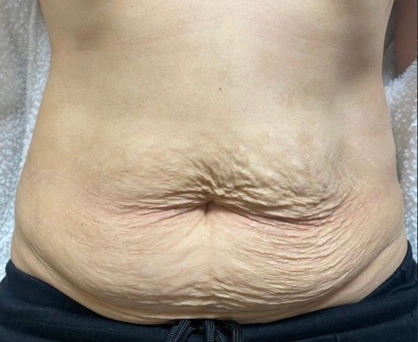 Lower torso with prominent abdominal skin folds and stretch marks, wearing dark pants