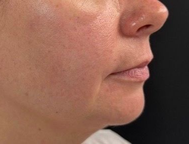 Side profile of a person with a reddish facial rash and swollen ear against a dark background