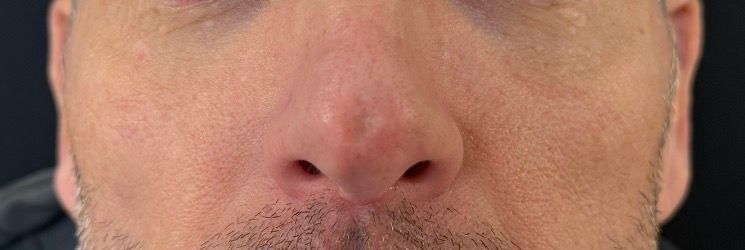Close-up of a person's nose and mouth with a mustache and light skin.