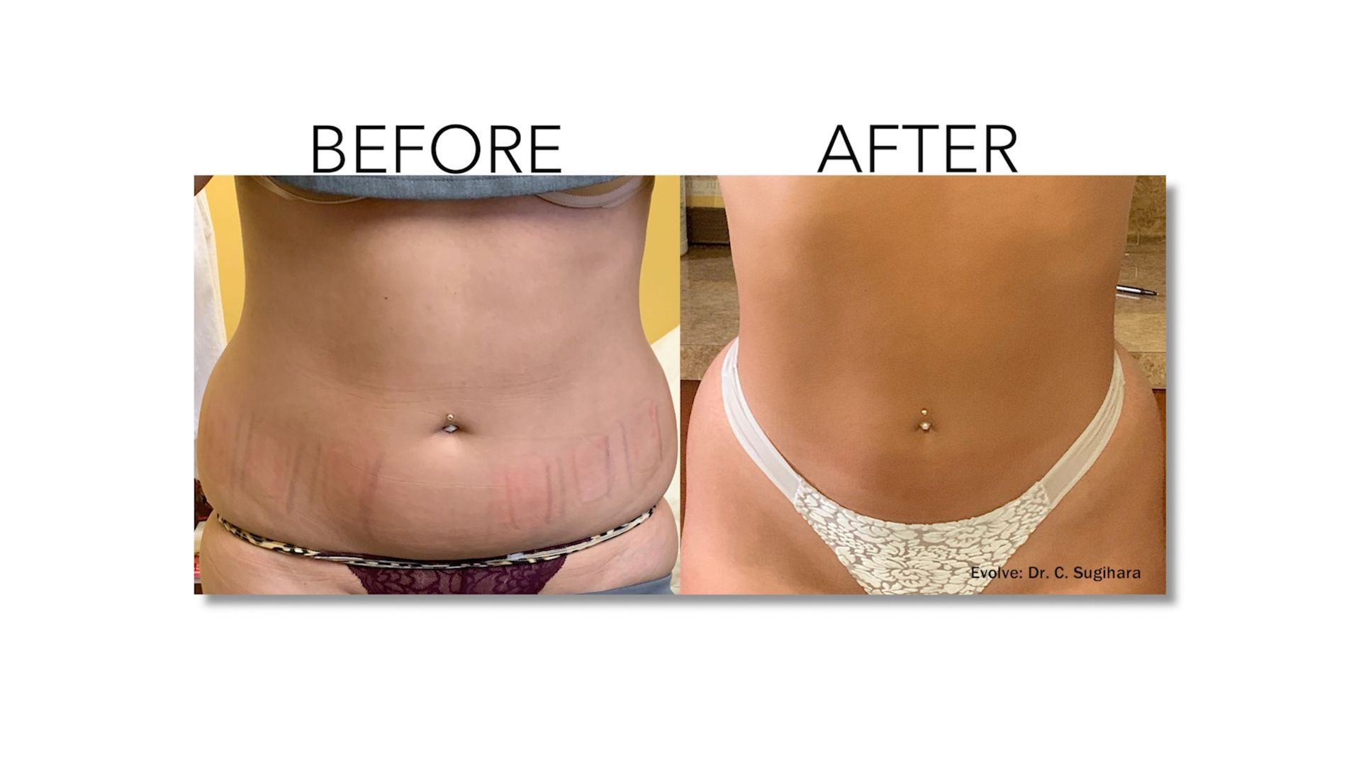 A before and after picture of a woman 's stomach.