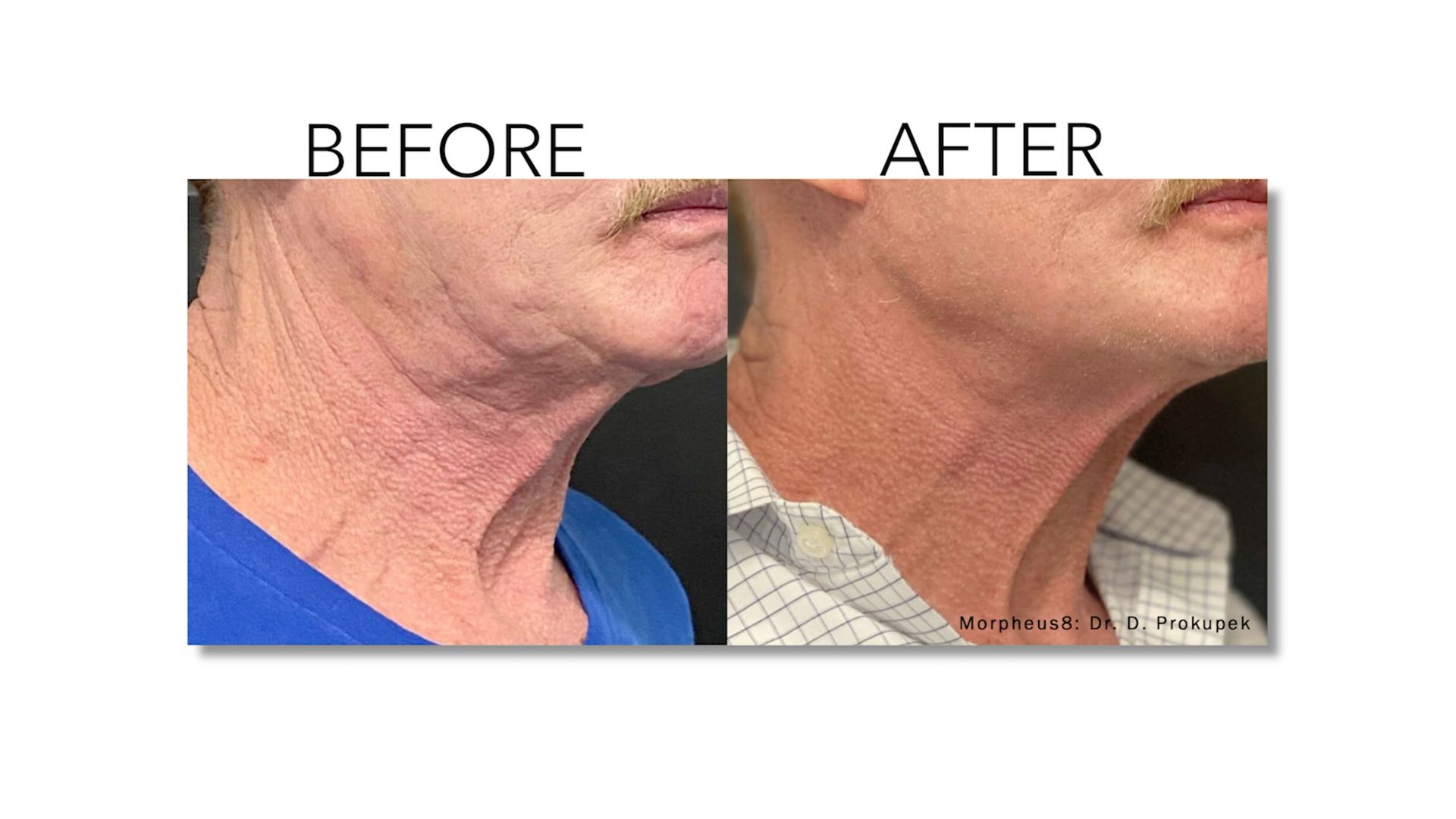 A before and after picture of a man 's neck