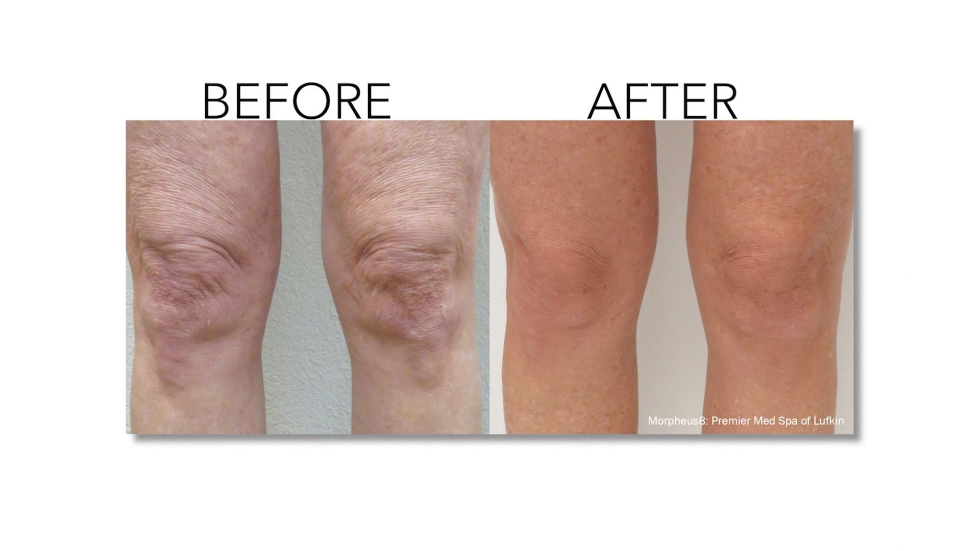 A before and after photo of a person 's knee