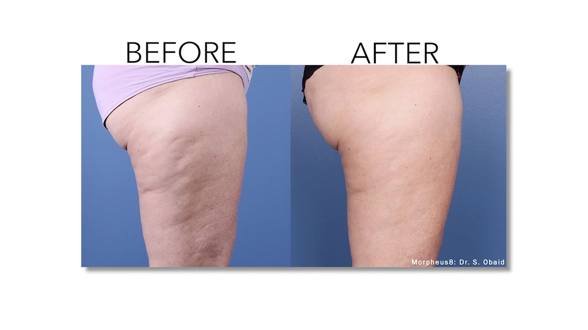 morpheus body before & after