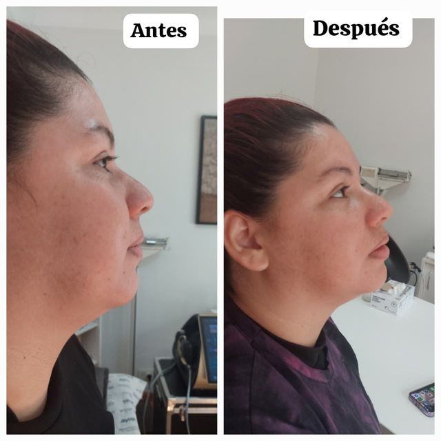 Antes y después de una mujer de perfil en interiores, mostrando un cambio en la postura del mentón.